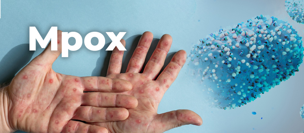 Mpox Found in Wastewater in North Carolina